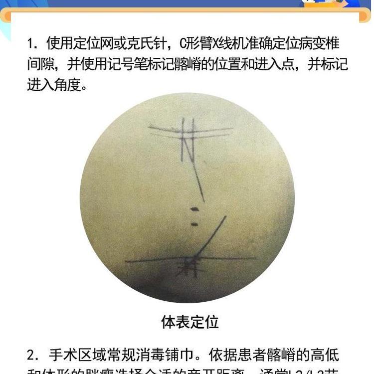 德國(guó)費(fèi)格椎間孔內(nèi)窺鏡ZKJ-1型進(jìn)口脊柱單入路可視微創(chuàng)主鏡