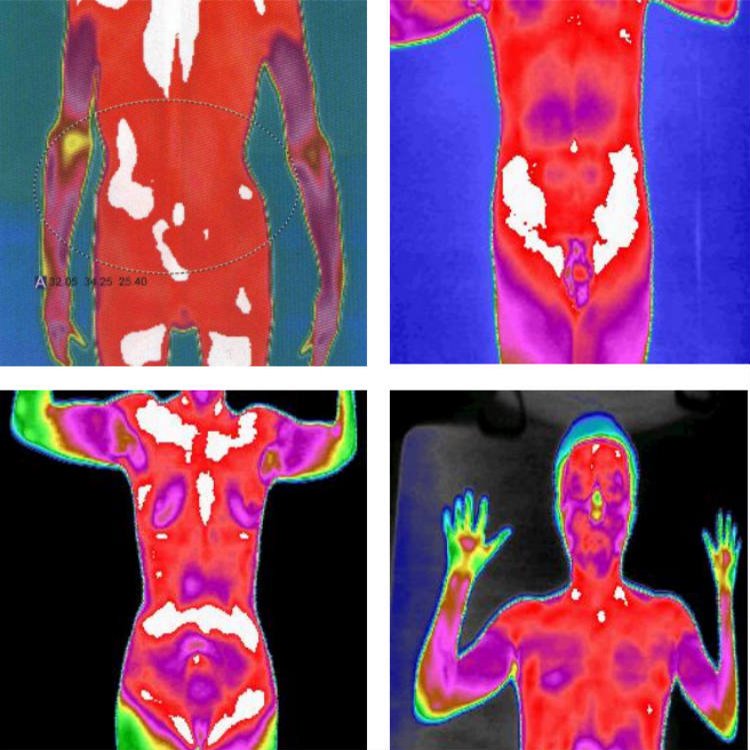 紅外成像檢測(cè)儀器醫(yī)用紅外熱像儀的功能中醫(yī)可視化影像檢測(cè)設(shè)備